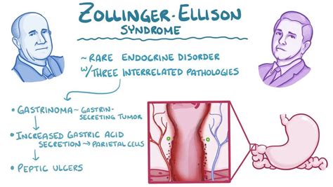 Symptoms Of Zollinger Ellison Syndrome