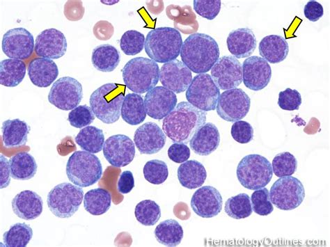 T Cell Lymphoblastic Lymphoma