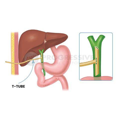 T Drain Tube