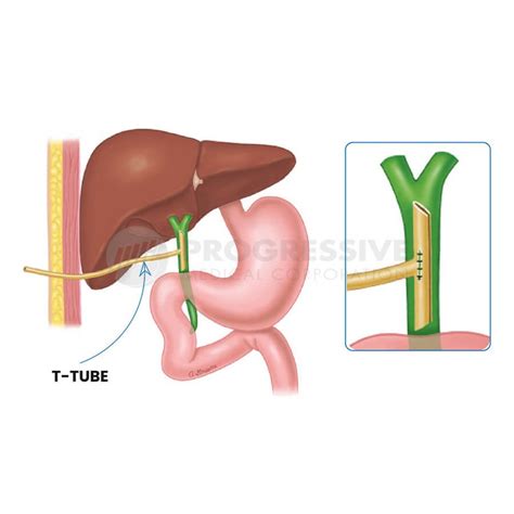T Tube Drain