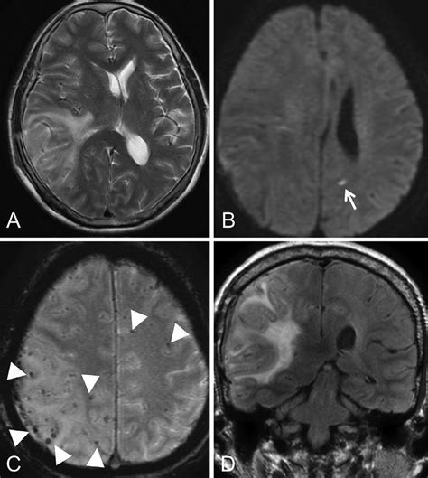 T2 Hyperintense Lesion