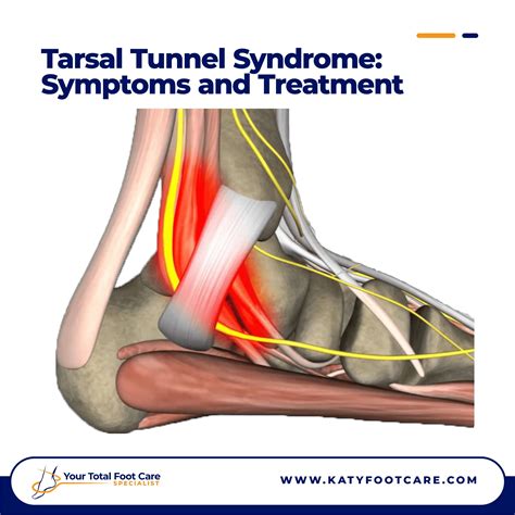 Tarsal Tunnel Syndrome Remedies
