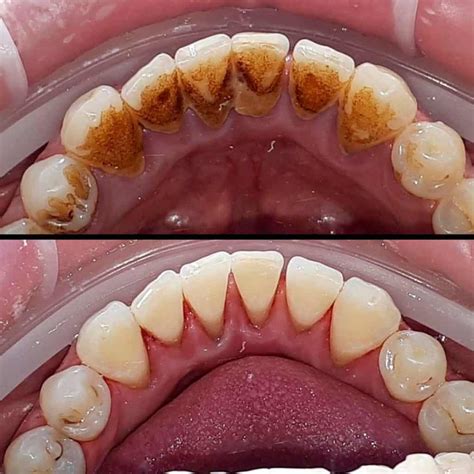 Tartar Breaking Off Teeth