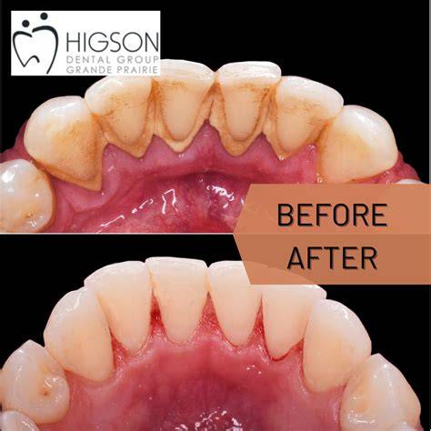 Tartar On Teeth Removal