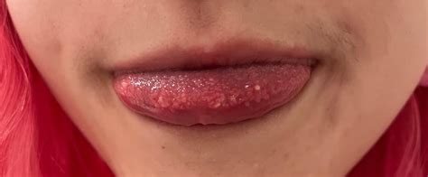 Taste Buds Are Inflamed