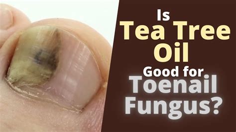 Tea Tree Oil Toe Fungus