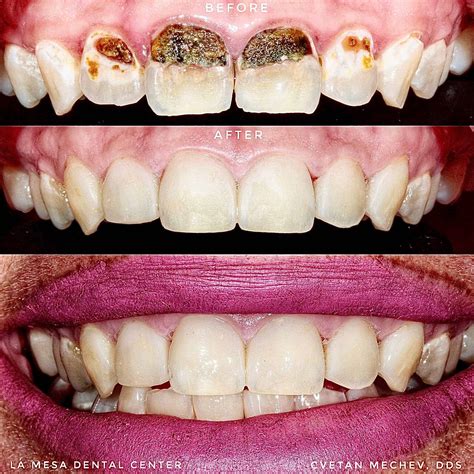 Teeth And Fillings