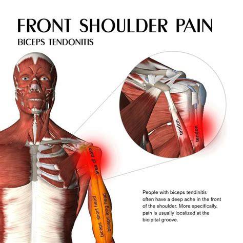 Tendonitis Shoulder Pain Treatment