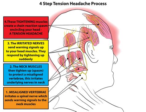 Tension Headache Therapy