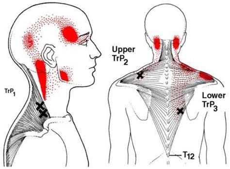 Tension Points In Neck