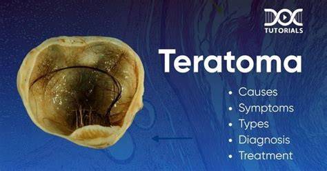 Teratoma Cancer Pictures