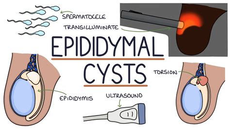 Testicular Cyst Images