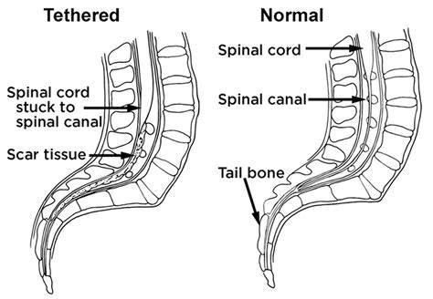 Tethered Cord Symptoms