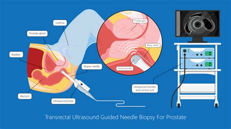 The Truth About Prostate Biopsy