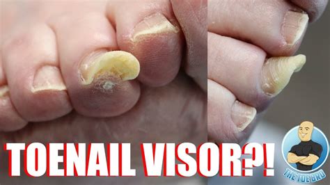 Thick Fingernails And Toenails