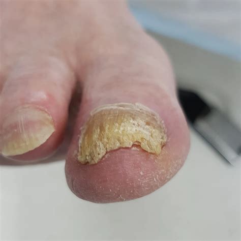 Thick Toe Nails