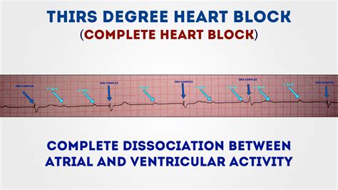 Third Degree Heart Block Complete