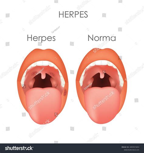 Throat Herpes Images