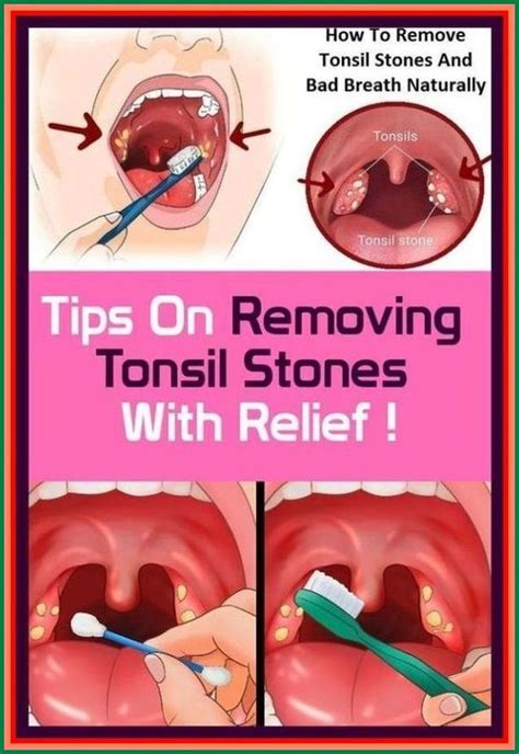 Throat Stones Home Remedies