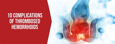 Thrombosed Piles Images