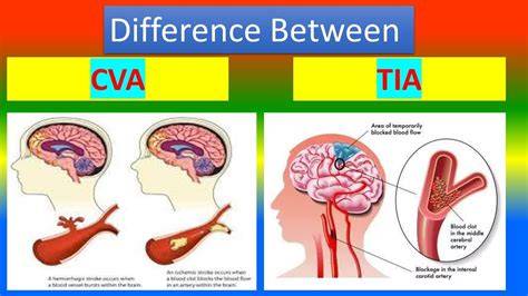 Tia Vs Cva