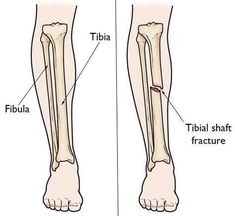 Tibia Fracture Symptoms