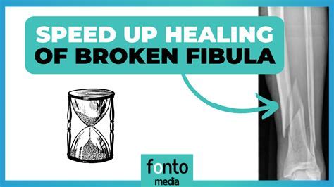 Time To Heal Broken Fibula