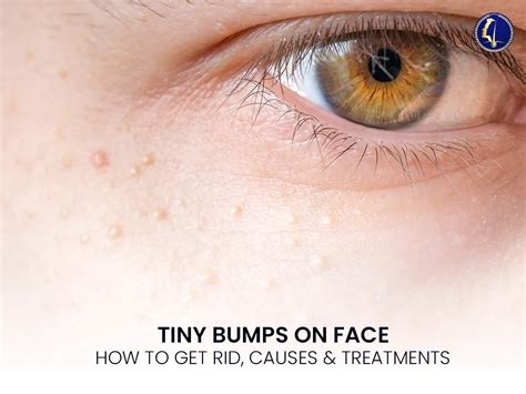 Tiny Bumps On Face