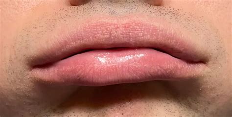 Tiny Bumps On Lips