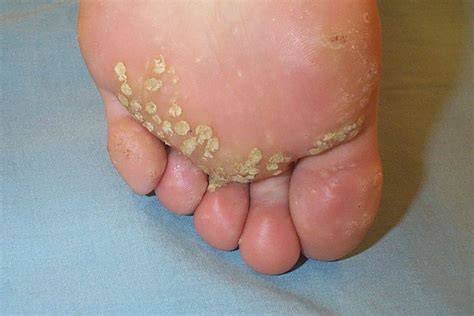 Tiny Foot Warts