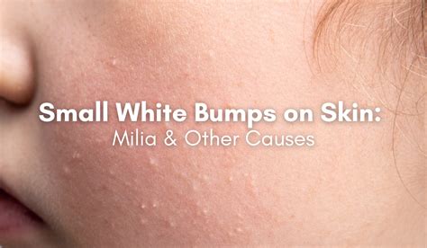 Tiny White Bumps On Face