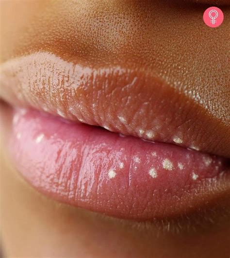 Tiny White Bumps On Lips