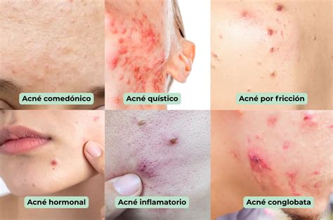 Tipos De Acne