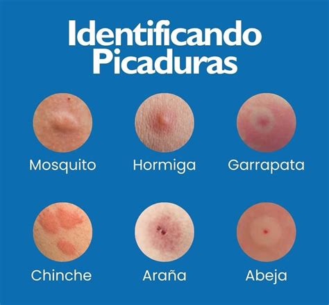 Tipos De Picaduras De Arañas