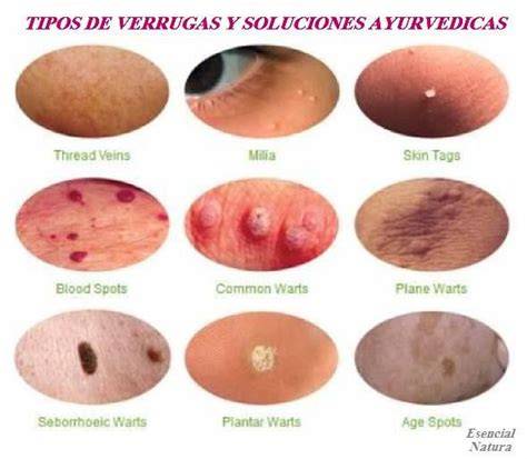 Tipos De Verrugas Fotos