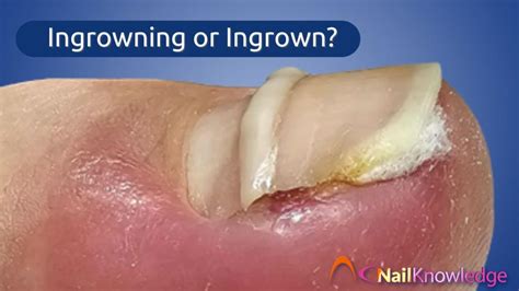 Toe Nail Growing Under Toenail