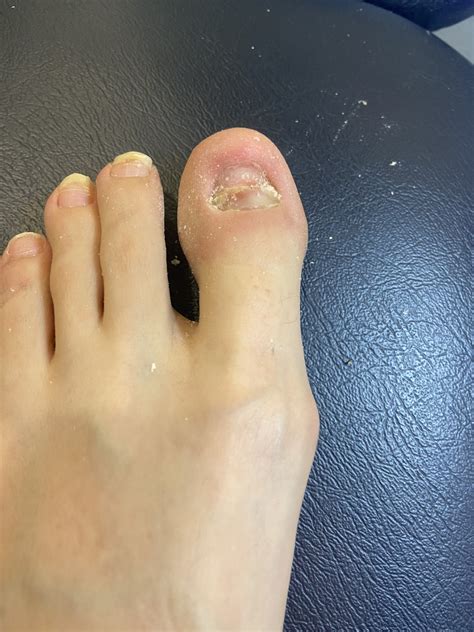 Toe Nail Removal