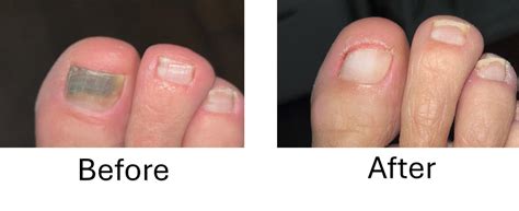 Toenail Detached From Bed