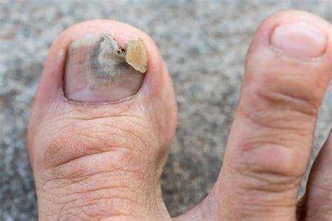 Toenail Fungus Painting Nails