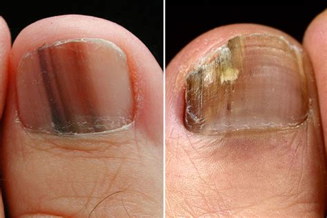 Toenail Melanoma Pictures