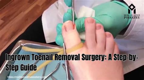 Toenail Removal Aftercare