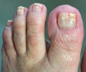 Toenails With White Marks