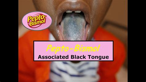 Tongue Black Pepto