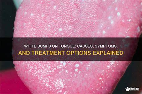 Tongue Is White With Bumps