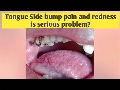Tongue Lumps On Side