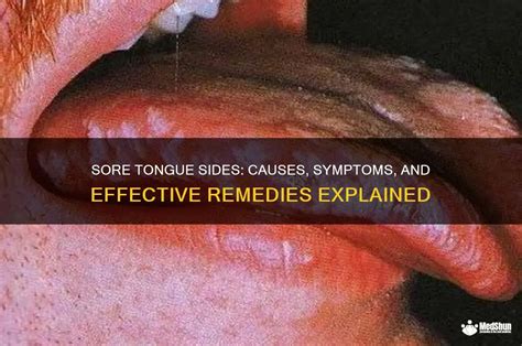 Tongue Soreness On Sides