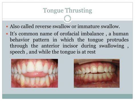 Tongue Thrust In Adults
