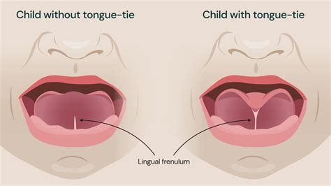 Tongue Tied Infant Symptoms