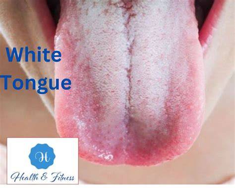 Tongue White At The Back