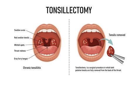 Tonsil Removal Surgery